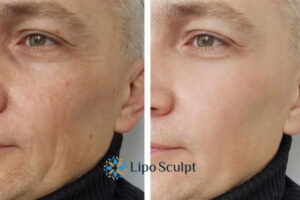 Fight Aging Symptoms Brownhills With HIFU and Morpheus8 Today!