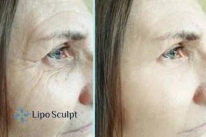 Do you want to Fight Aging Symptoms Brownhills? Contact Lipo Sculpt today!