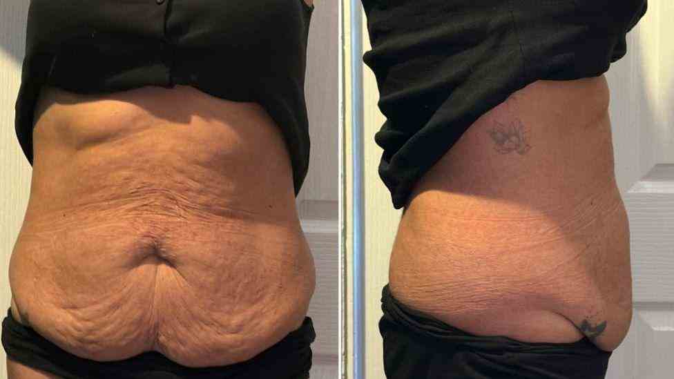 Lost the Weight but Not the Loose Skin? What You Should Know 1 Is It Definitely Loose Skin Brownhills?
